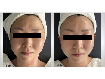 マリー エクラン/30代 女性 リフトUP施術