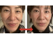 オリファインサンサン(Orefine33)/落ちた瞼が目元パッチリで小顔に