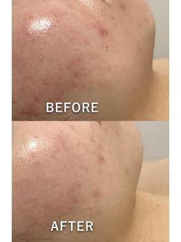 ソラ(Sola)/ニキビケア