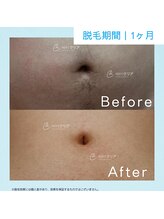 メンズクリア 武蔵小杉店/【メンズクリア】お客様の施術例