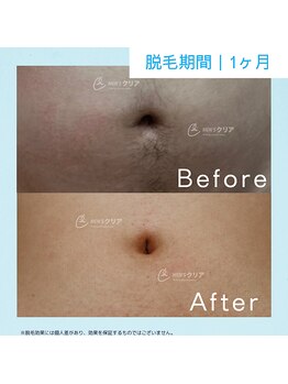 メンズクリア 武蔵小杉店/【メンズクリア】お客様の施術例