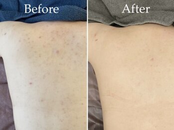 リッチ(Rich+)/背中ハーブピーリング