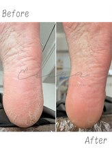 エレナ(ERENA)/かかと角質　足のタコ除去！
