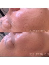 WA ネイル アンド ビューティー(WA nail & beauty)/ホワイトスノーピール