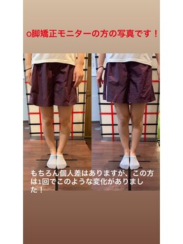 目黒もりおか整骨院/O脚矯正ビフォーアフター