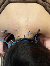 瑞 鍼灸院/肩首ケア付き美容鍼