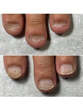 トレフル(Trefle)/深爪矯正/爪噛みむしり癖/4回目