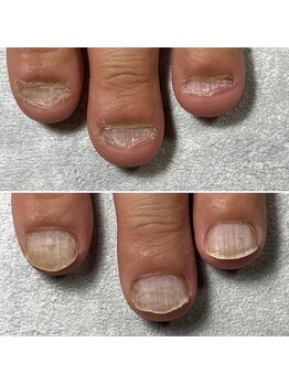 深爪矯正/爪噛みむしり癖/4回目