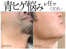 スポット 薬院駅前店(SPOT)/#脱毛 #ヒゲ脱毛 #毛 #SHR #IPL