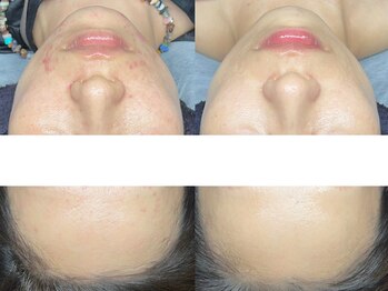 エモーショナル 姫路(Emotional)/ピーリング×機械で早期改善