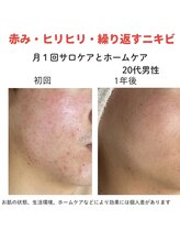 ダーウィン(Darwin)/赤み・ヒリヒリ・繰り返すニキビ