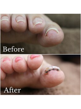 【巻き爪矯正】1回目