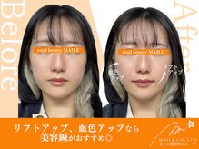 まいれ鍼灸整骨院 整体院 長浜院/美容鍼（20代女性/施術1回目）
