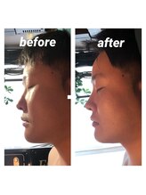 伊達男/フォースカッター事例（小顔）