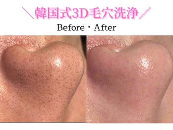 ダイヤモンド リーエンダ(Diamond leende)/韓国式3D毛穴洗浄