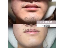 ソフニスの雰囲気（当店で脱毛をされたお客様の変化の記録です。顔ヒゲ全体脱毛16回）