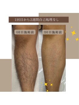 ルウム 名古屋駅店(lum)/脱毛lum/膝下　Before/After