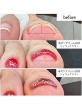 ケアプラス(care plus)/巻爪ケア