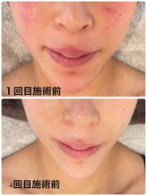 トゥモロー(TOMORROW)/ハーブピーリング/肌質改善