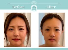 美人バスト 本厚木店/【小顔コルギ】☆症例