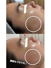 トモニ(TOMONI)/ダクトピールフェイシャル1回