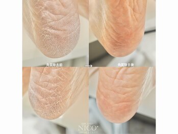 ニコプラス 大橋店(NICO+)/足裏角質除去