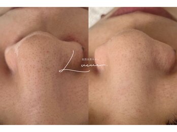リュール(Lueur)の写真/毛穴、何をしても繰り返していませんか？原因に合わせて整える、繰り返さない毛穴ケア◎