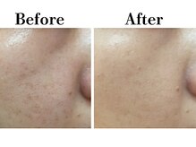 ビースキン 広島(BE:SKIN)/乳酸菌ピーリング/毛穴ケア