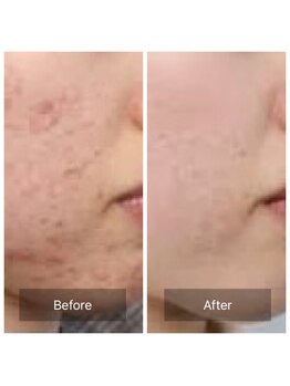 エフイチキュウサン(f.193)/【肌質改善】IPLフェイシャル