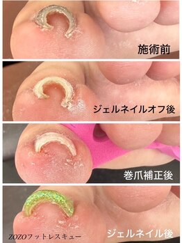 ゾゾ イリプレッセブル(ZOZO irreplaceable)の写真/特許取得の高技術★足のトラブルの救世主（巻き爪/変形/痛み/腫れ/タコ/魚の目）すべておまかせ!!