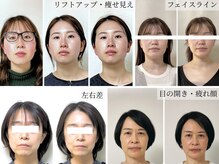 ミラ 長崎駅前店(MIRA)の雰囲気（エラ_中顔面短縮_むくみ_ブライダルエステ_小顔矯正_たるみ改善）