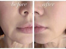 グラッソ(GRASSO)/マイクロウェーブ深層リフト