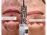 メンズニキビ本格ケアセット定価78,000円｜ハーブピーリング1回＋水玉LDM2回