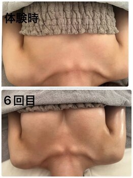 美人バスト 新宿店/☆姉妹店バストアップ症例写真☆