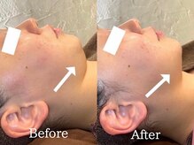 ルーミー 南青山(LUME)の雰囲気（痛みに弱い方でもOK！お客様に合わせて照射いたします★）