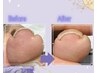 【お試しキャンペーン】巻き爪+ワンカラーset