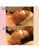 プリマジュール/ニキビケア（オーダーメイドF）