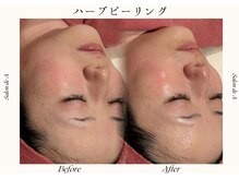 サロンドエー 帝塚山(Salon de A)/ハーブピーリング