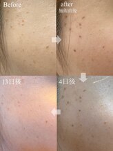 コリー(Kolly)/シミケア