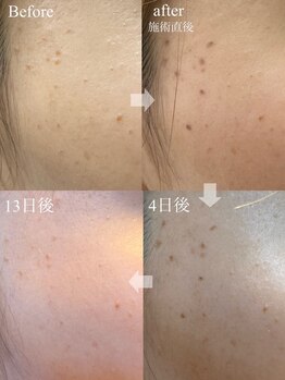 コリー(Kolly)/シミケア