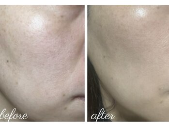 エースマイルイズ(A smile is..)/ハーブピーリング