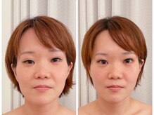 ベリンダ(belinda)/別人級小顔コルギbefore→after