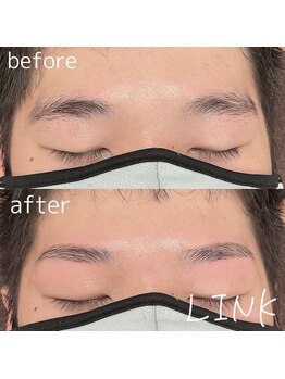 リンク(LINK)/眉毛症例