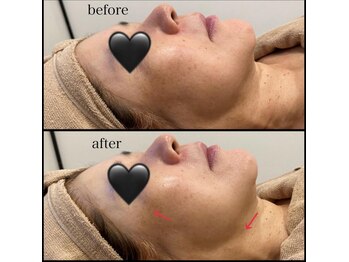 シュバル(CHEVAL)/しわ、たるみにお悩みの方はBBL