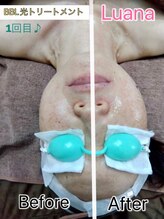 ルアナ(Luana)/BBL光トリートメント！