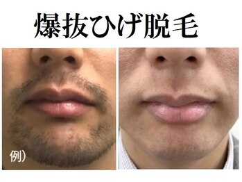 美肌プロジェクト カーラ 東川口店(CARA)/【メンズ脱毛】爆抜ひげ脱毛
