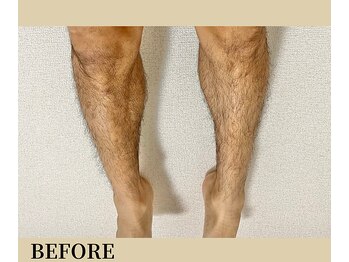 リノ(Lino)/脱毛前