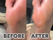 ポドロ ウィズ ニコルル 大阪天満店(PoDoLo with Nicolulu)/【魚の目】フットケア大阪・梅田