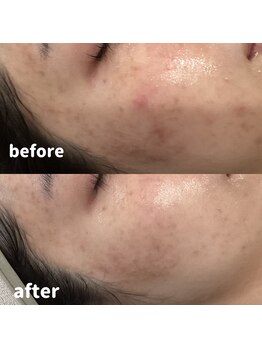 レアビューティー(Le'a beauty)/アクアダーマお悩み別美容液導入