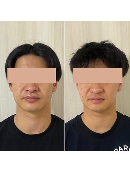 サロン ウェル(SALON WELL)/【30代 リフトアップ/法令線】